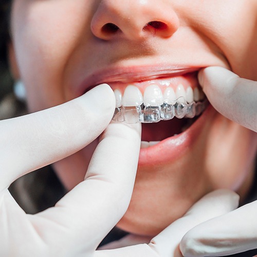 Dentist putting clear aligner on patient