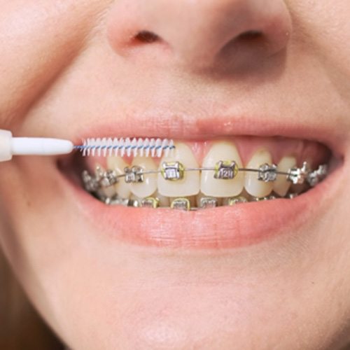 Nose-to-chin view of a woman brushing her braces with a special flosser