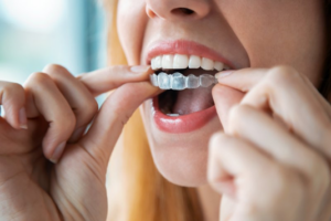 Close up of woman inserting an Invisalign tray